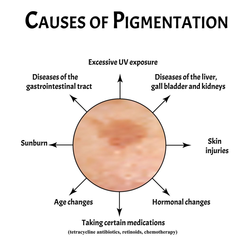 pigmentation-skinrx-aesthetic-clinic-pty-ltd